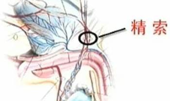 精索静脉曲张的治疗方法有哪些
